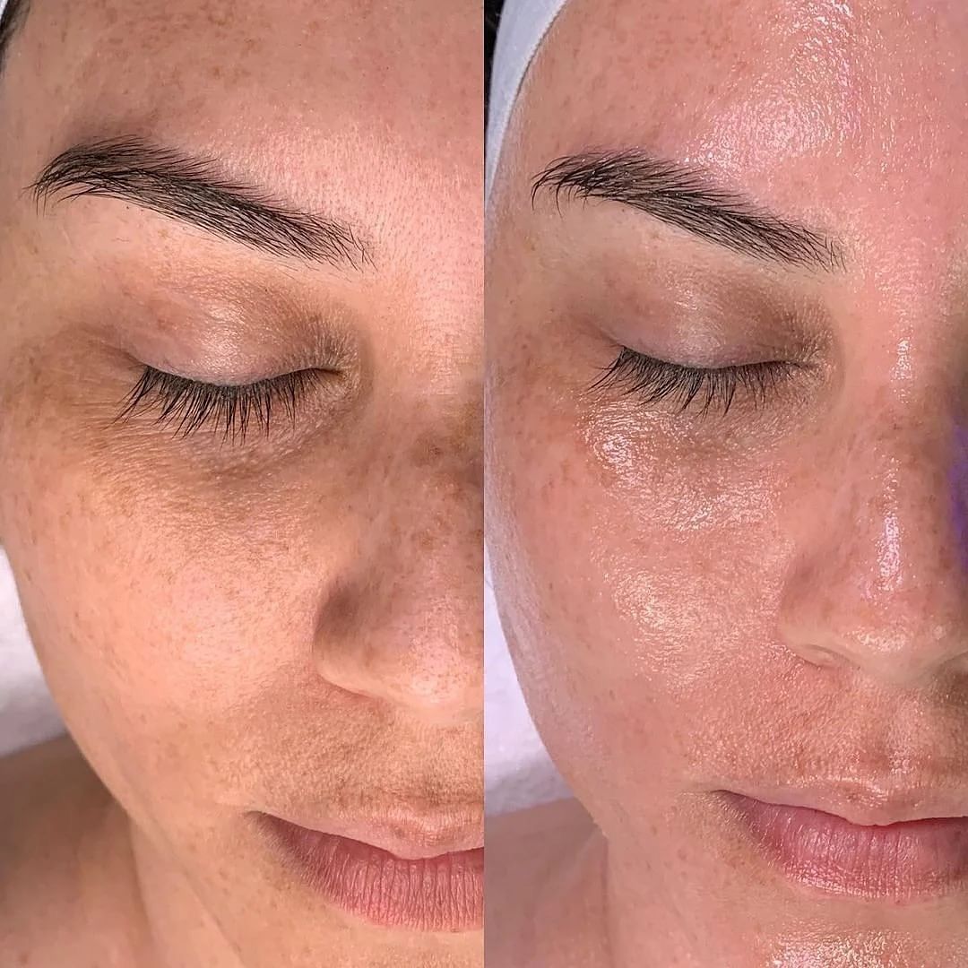 Collagen facial before and after, jawline and lower face